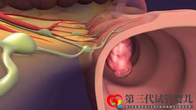 研究：基因操纵结肠癌细胞中的蛋白质水平可以改善化疗情况(图3)