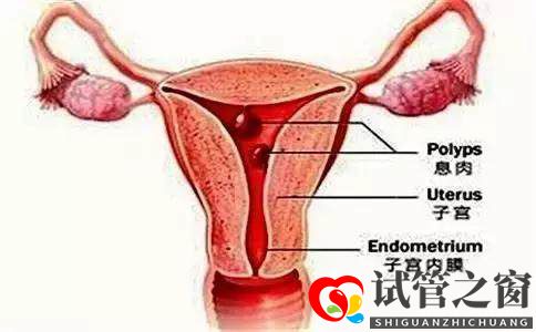 试管之窗:子宫内膜有息肉要切除才能做试管婴儿吗(图2)