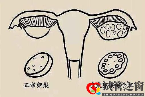 多囊促排怀孕成功率大吗？(图1)