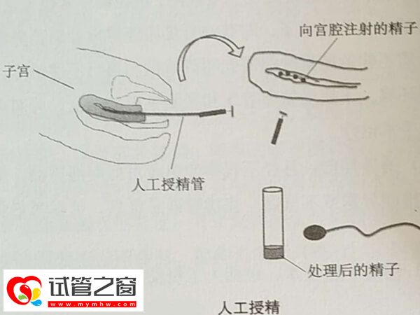 人工授精手术过程